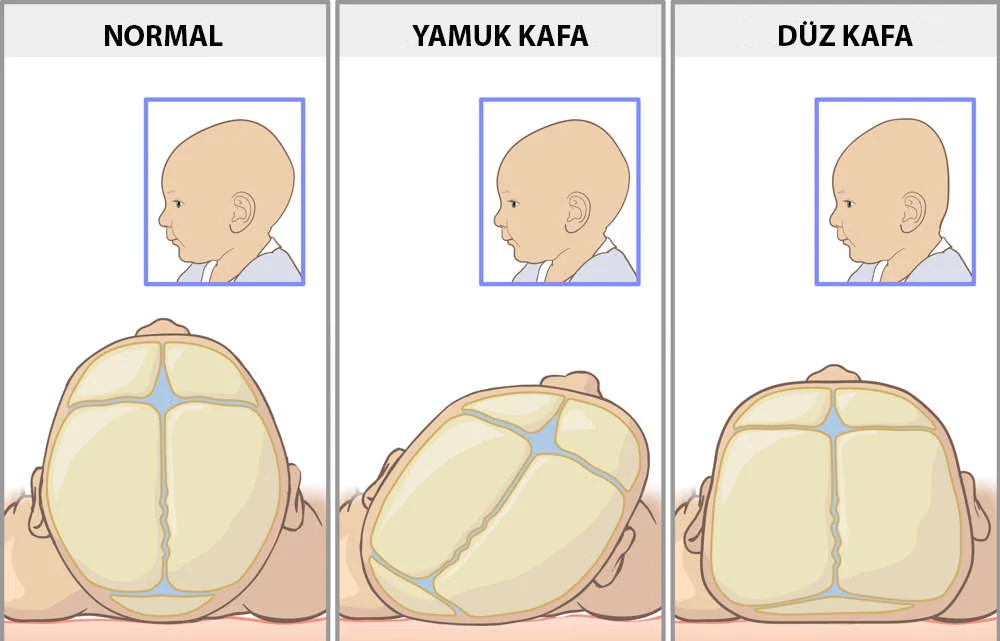 Positional Plagiocephaly - an example of flat head syndrome in infants