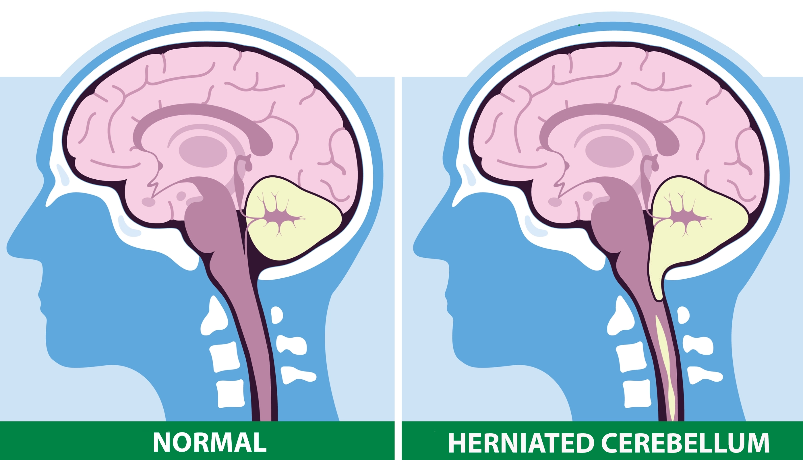 Chiari malformation MRI illustration