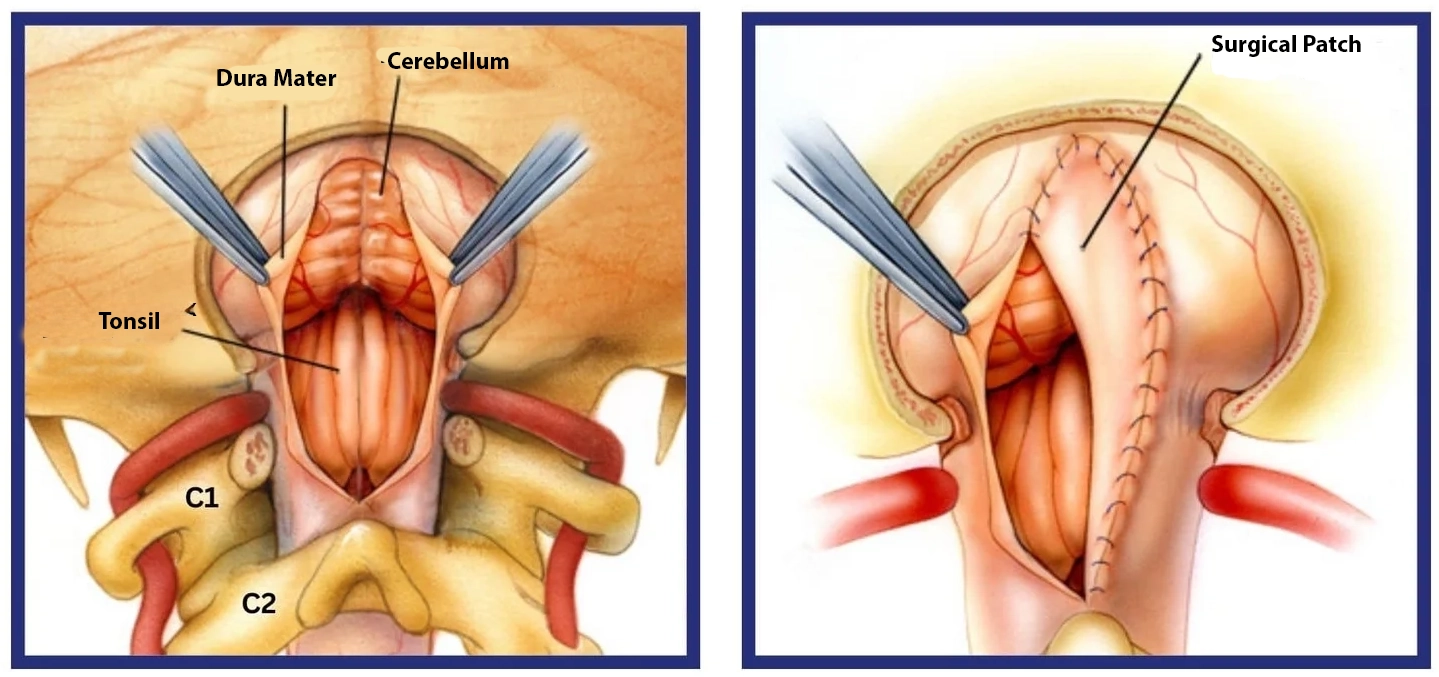 Chiari malformation surgery illustration