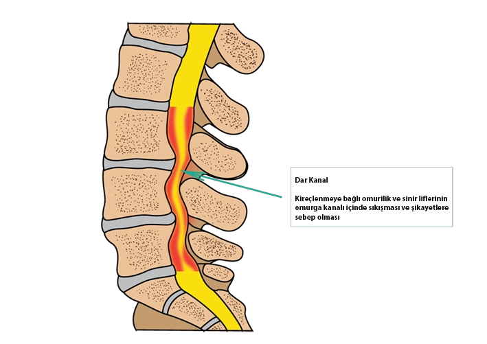 Anatomical view of spinal stenosis