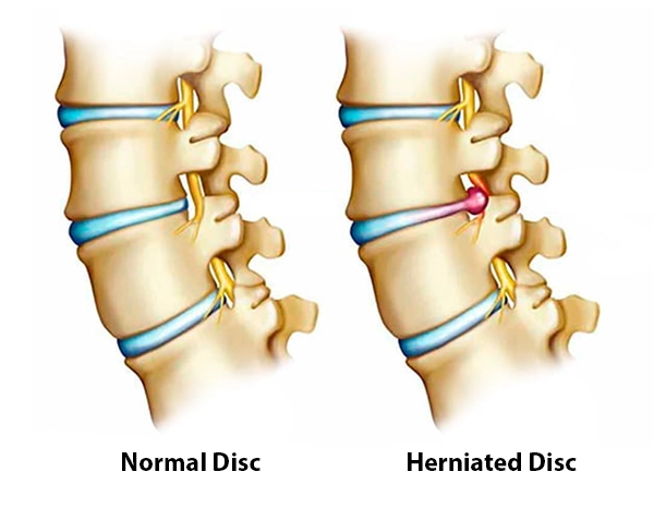 Cervical disc