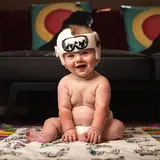 Positional plagiocephaly